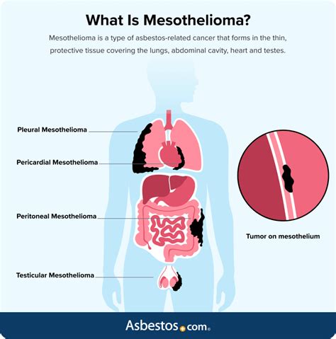 Understanding the Different Types of Mesothelioma