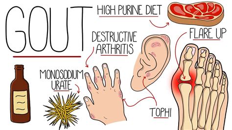 Understanding the Enemy What Exactly is Gout