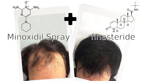 Understanding the Science Behind Finasteride and Minoxidil