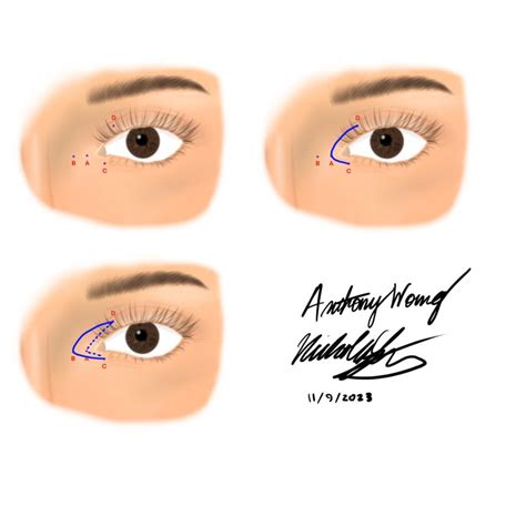 Understanding the Techniques: Canthoplasty and Its Variations