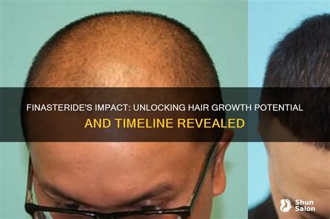 Unlocking Hair's Potential: The Transformative Power of Finasteride