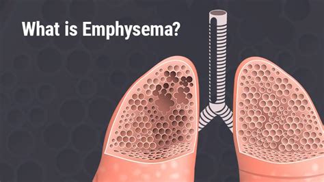 Unpacking Emphysema