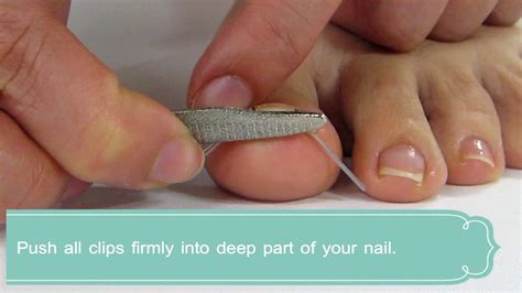 Use a Nail Straightening Clip or Splint