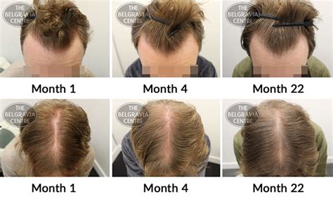Using Minoxidil Long-Term