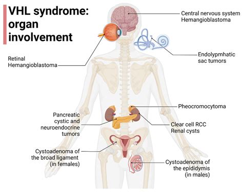 VHL Central The Hidden Connection Between VHL and Cancer