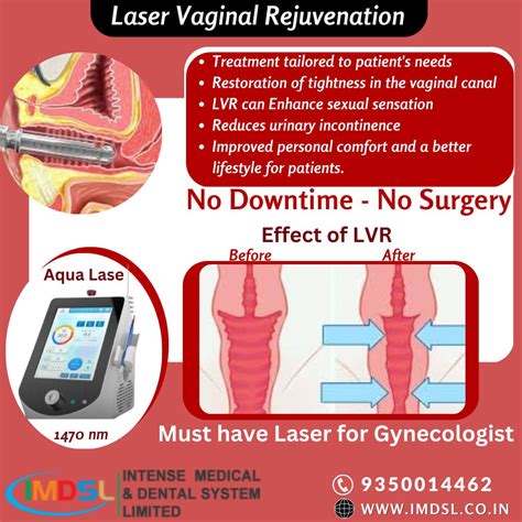 Vaginal Rejuvenation