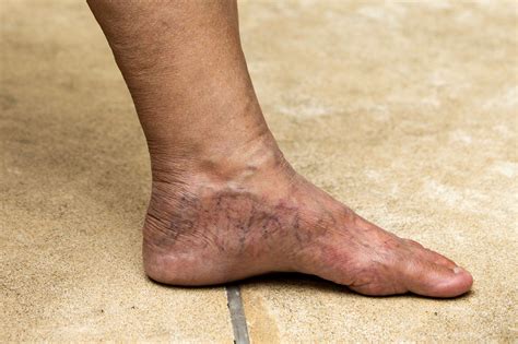 Veins Ankle