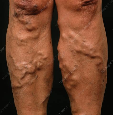 Varicose Veins Legs