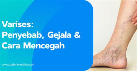 Varises