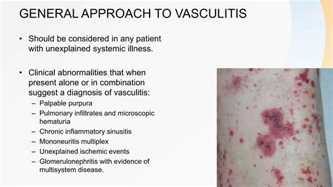 Vasculitis Panel Test and interpretation