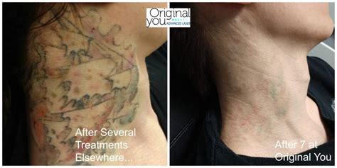 Vegas Tattoo Removal