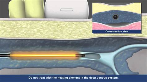 See how Venefit Procedure works: Procedural Animation a Step-by-Step Guide