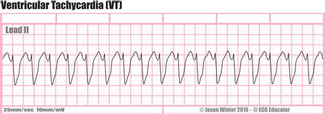 Ventricular Tachycardia