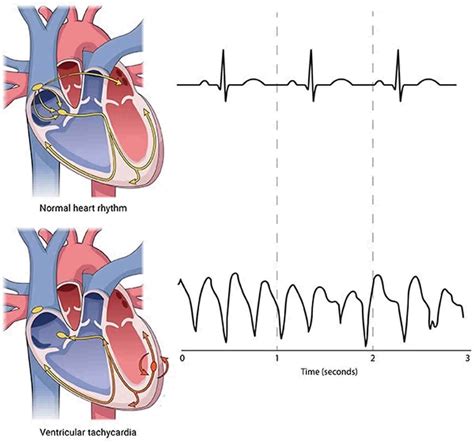 Tachycardia Heart