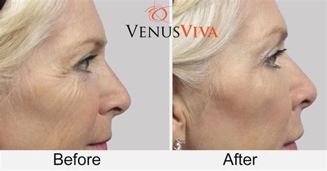 Unlock the Secret to Radiant Skin with Venus Viva Skin Resurfacing - Your Ultimate Guide to Flawless Complexion