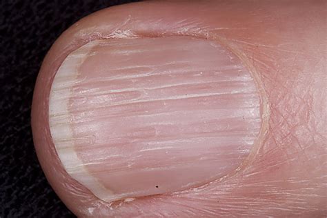 Vertical Ridges on the Fingernails Stock Photo Image of abnormal
