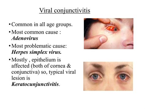 Viral Conjunctivitis (The Most Common Type)