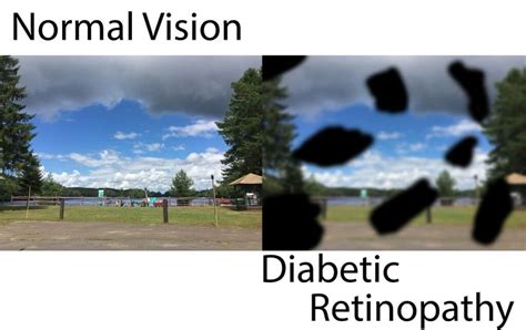 Vision Loss and Diabetic Retinopathy