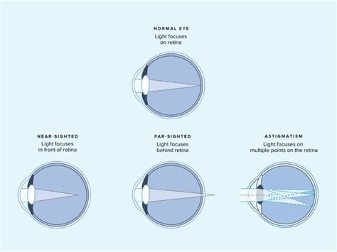 Visual Acuity and Refraction Testing