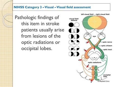 Visual Field Assessment with the NIHSS