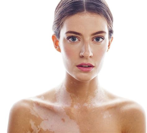 Vitamine B12 et Vitiligo