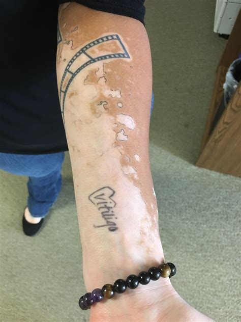 tattoo vitiligo skin Vitiligo skin, Tattoos, Vitiligo