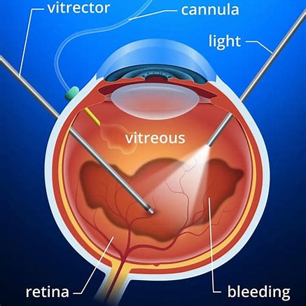 Vitrectomy