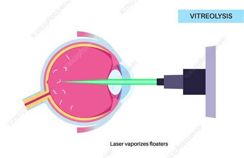 Potential Side Effects and What to Watch For