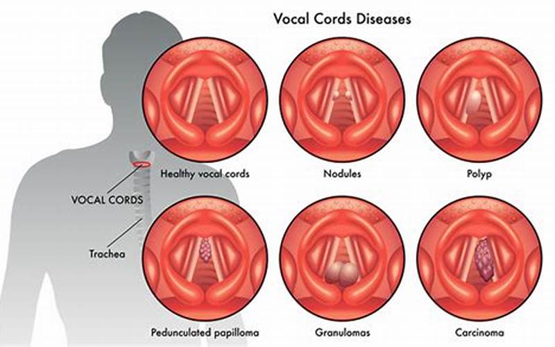 Vocal Nodules