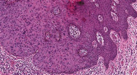Vulvar