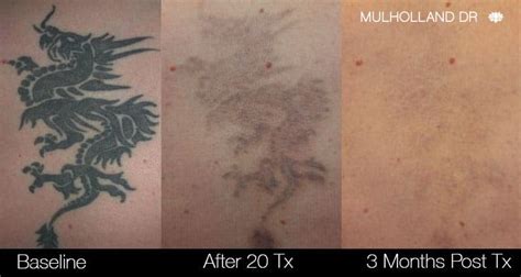 LYUMO Tattoo Remover Cream, Natural Plant Extract Tattoo