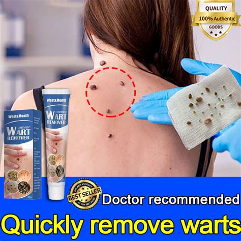 Warts Removal
