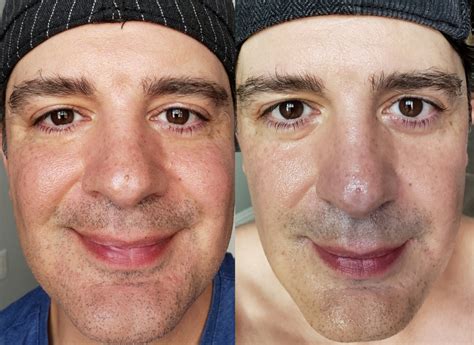 Reveal a Radiant New You: Water Fasting Skin Before and After Transformations