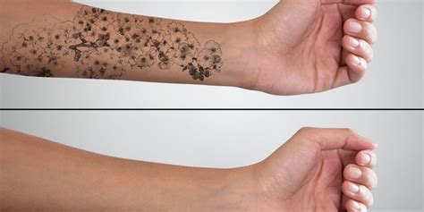 Permanent Tattoo Removal Simply Better Skin