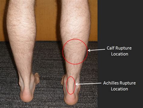 What Is A Torn Calf Muscle?