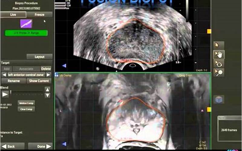 What Is Imaging-Guided Prostate Biopsy?