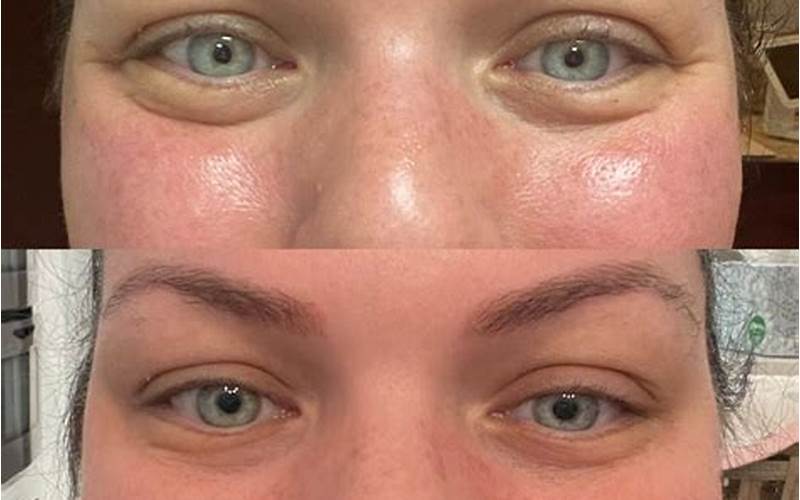 Jelly Roll Botox Before and After: What You Need to Know