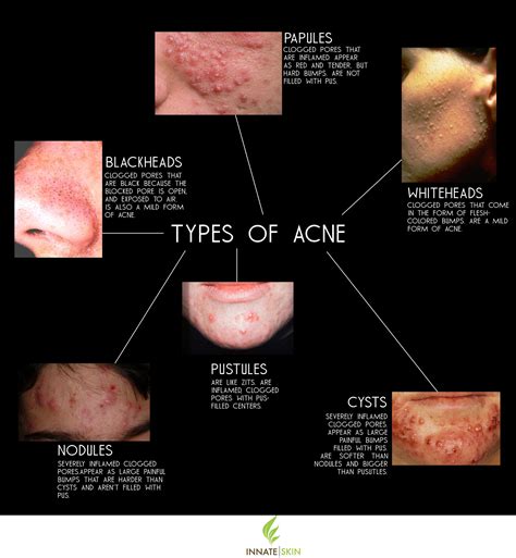 Acne Types, Symptoms, Causes & Treatments