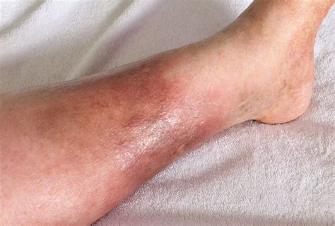 Discover How A Popped Vein Looks Like: Causes, Symptoms, and Treatment Options