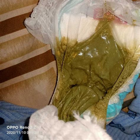Decoding the Appearance of Infant Diarrhea: Unraveling the Mystery of Your Baby's Bowel Movements