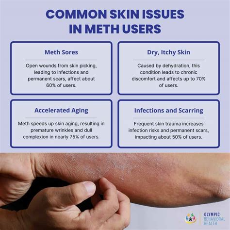 How Meth Impacts Skin: Surprising Findings Revealed!