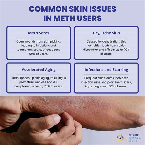 Methamphetamine: The Devastating Effects on Your Skin