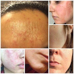 Signs of Over Exfoliated Skin: Spotting the Damage