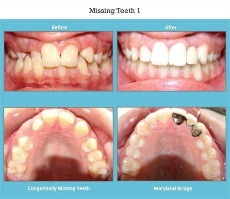 What If You Have Missing Teeth