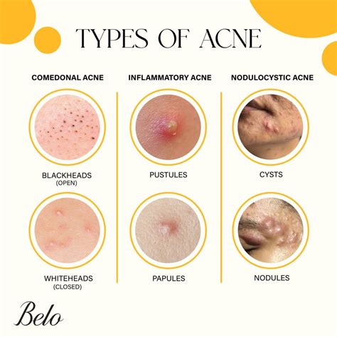 Acne and Congestion Elite Skin Studio