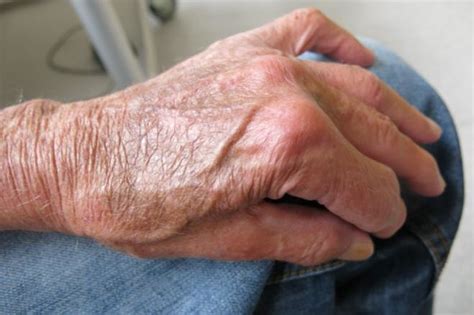 Skin Wasting Away: A Comprehensive Guide to Understanding Atrophy of the Skin