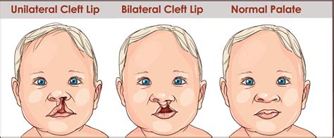 What Is Cleft Lip