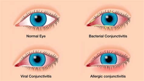 What Is Conjunctivitis