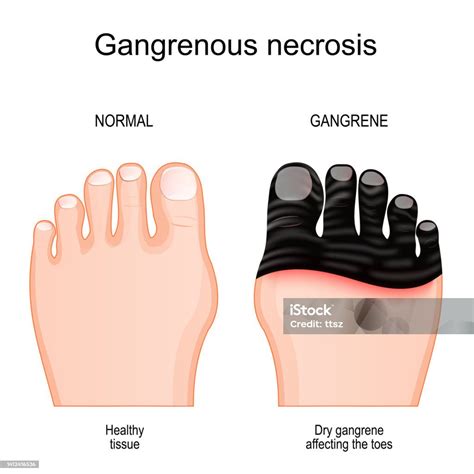 What Is Gangrene