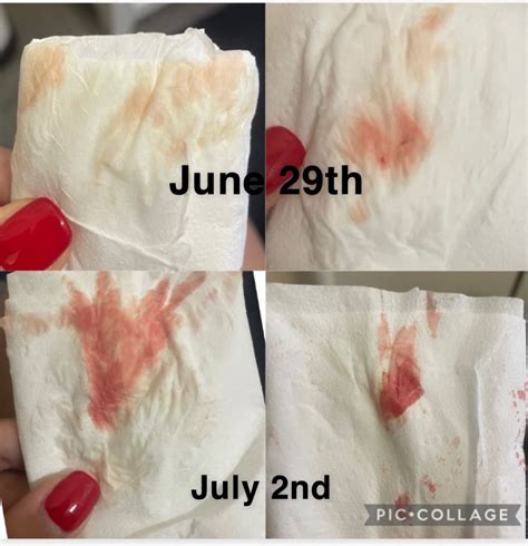 What Is Implantation Bleeding Like Reddit
